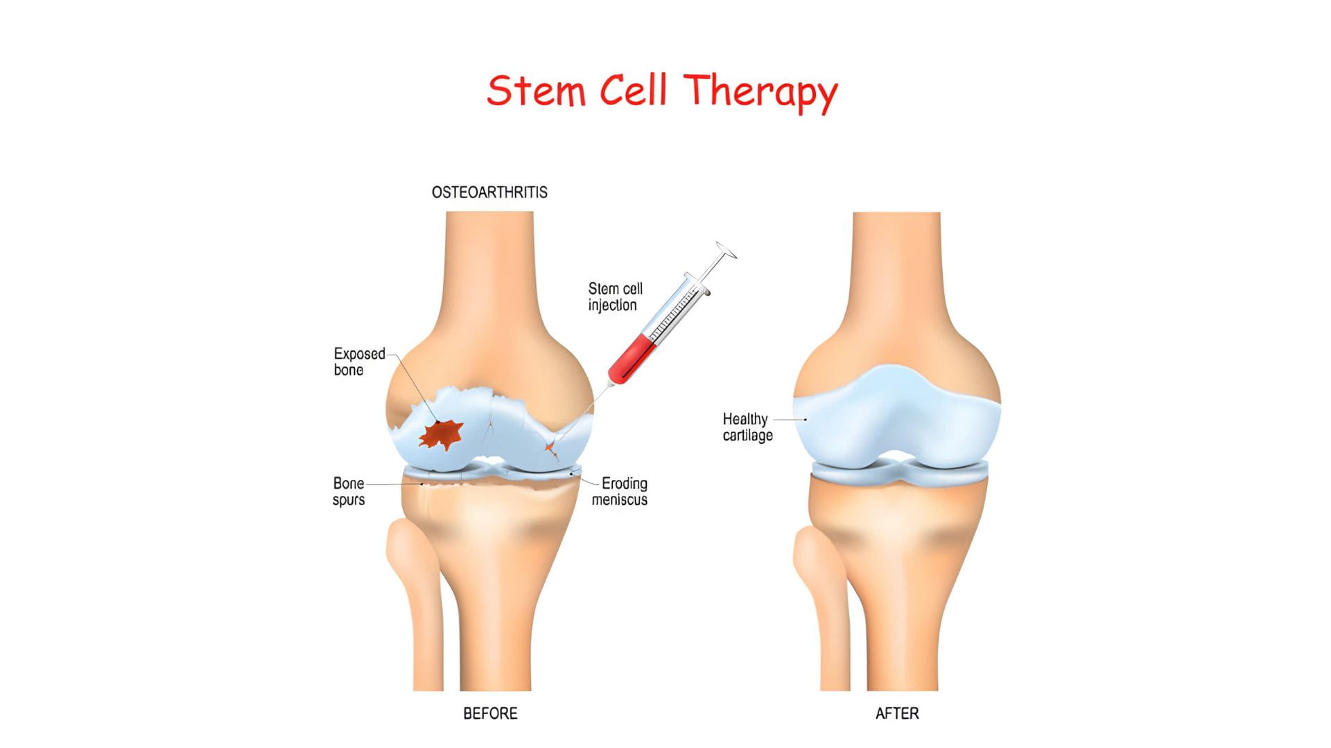 Knee Pain Therapy in Medellin Colombia with Stem Cell Treatment