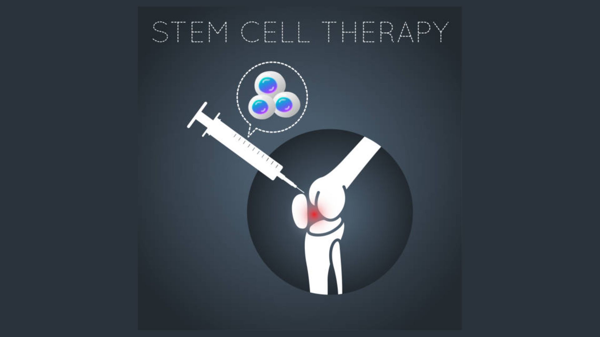 Stem Cell Therapy for Chronic Joint Pain in Medellin