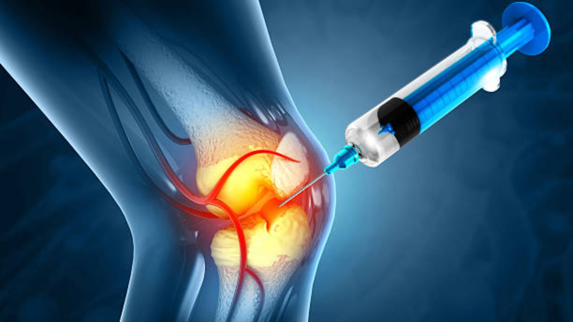 Stem Cell Therapy for Knee Pain Colombia