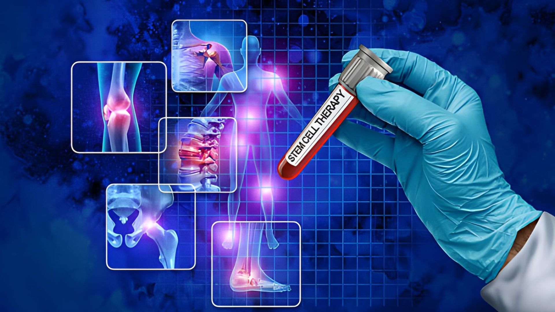 Stem Cell Treatment in Colombia Understanding Regenerative Medical Care