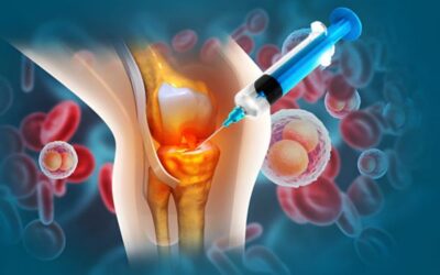 Before Joint Replacement: Could Stem Cell Therapy Be Considered?