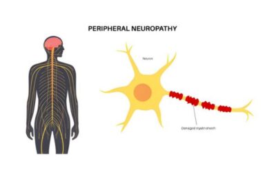 Peripheral Neuropathy: How Stem Cell Therapy Is Evaluated