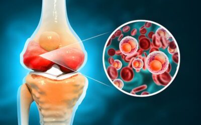 What to Know About Stem Cell Therapy for Arthritis