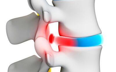Stem Cell Therapy for Herniated Disc: Evidence and Candidacy
