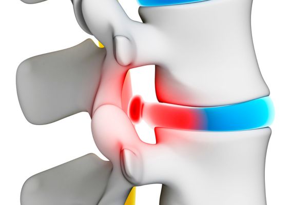 Stem Cell Therapy for Herniated Disc: Evidence and Candidacy